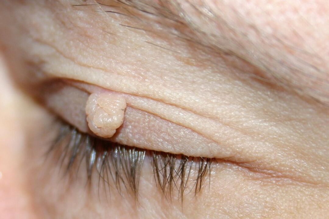 อาการของ papilloma บนเปลือกตา
